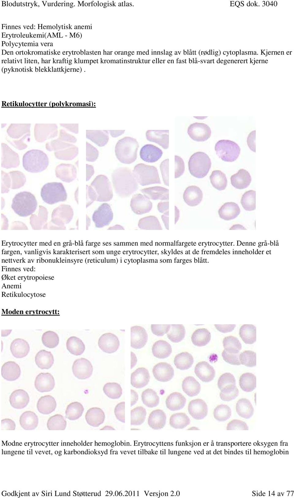 Retikulocytter (polykromasi): Erytrocytter med en grå-blå farge ses sammen med normalfargete erytrocytter.