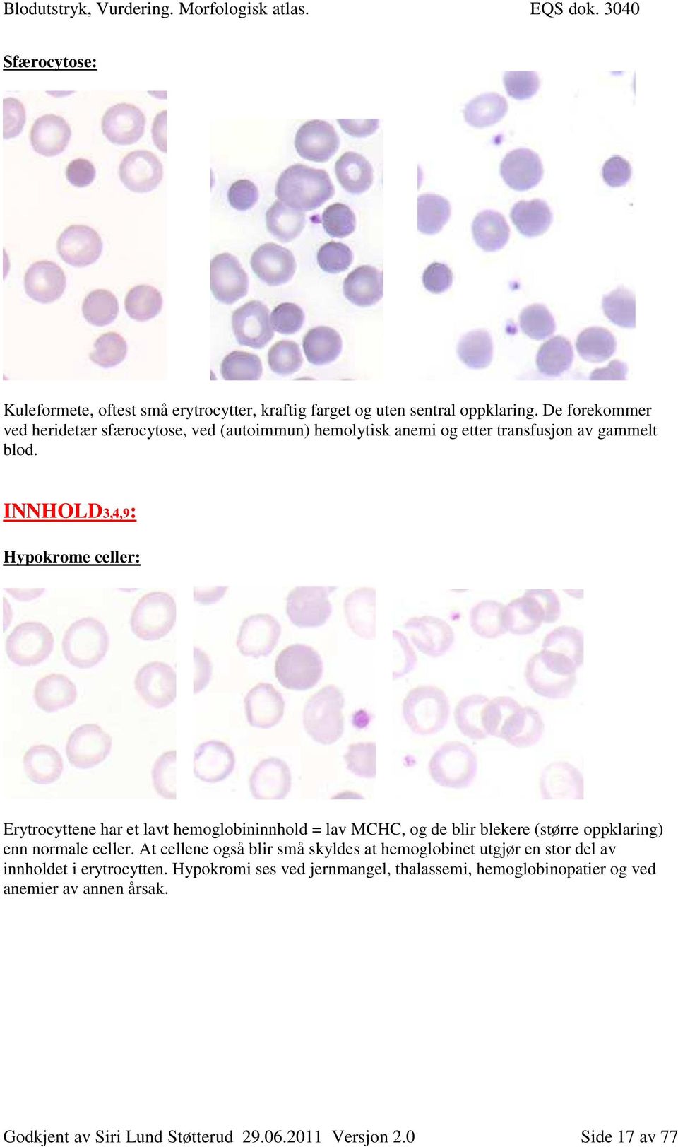 INNHOLD3,4,9: Hypokrome celler: Erytrocyttene har et lavt hemoglobininnhold = lav MCHC, og de blir blekere (større oppklaring) enn normale celler.