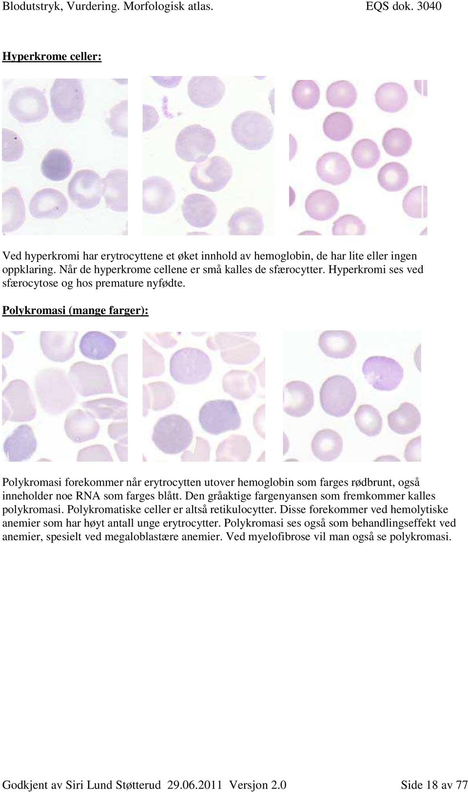 Polykromasi (mange farger): Polykromasi forekommer når erytrocytten utover hemoglobin som farges rødbrunt, også inneholder noe RNA som farges blått.