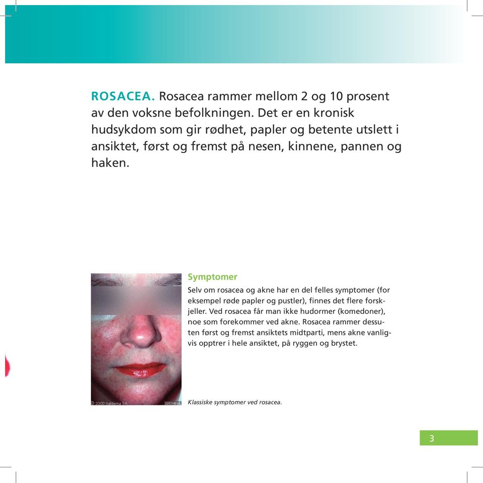 Symptomer Selv om rosacea og akne har en del felles symptomer (for eksempel røde papler og pustler), finnes det flere forskjeller.