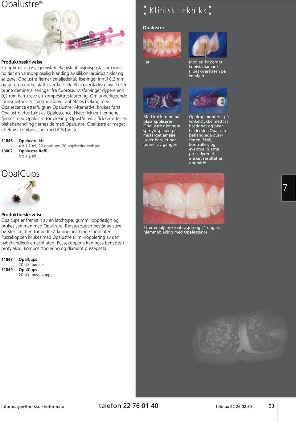 Misfarvinger dypere enn 0,2 mm kan kreve en komposittrestaurering. Om underliggende tann substans er sterkt misfarvet anbefales bleking med Opalescence etterfulgt av Opalustre.