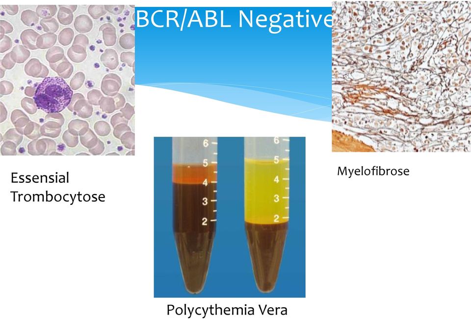 Trombocytose