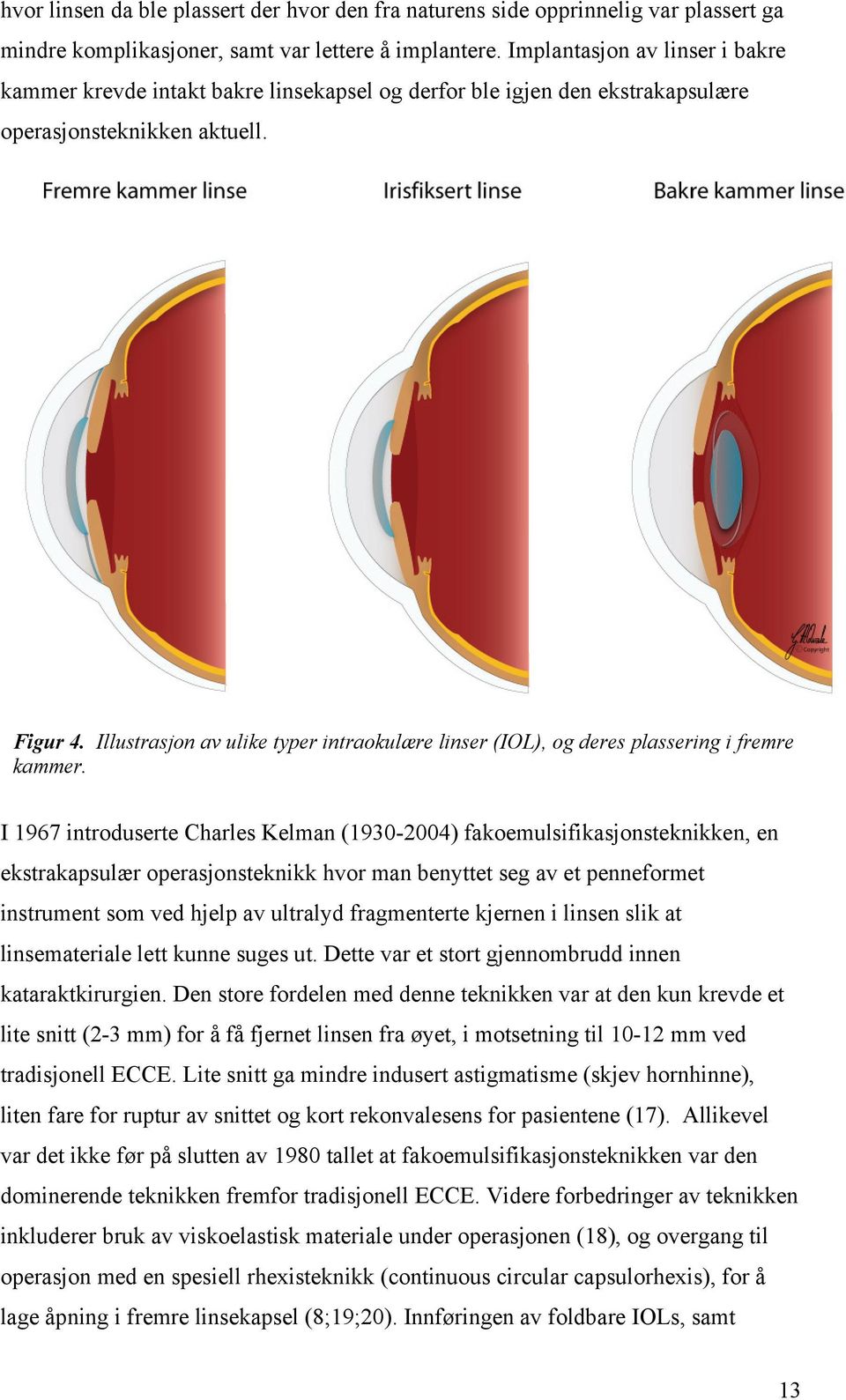 Illustrasjon av ulike typer intraokulære linser (IOL), og deres plassering i fremre kammer.