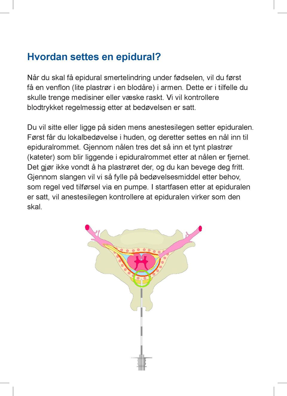 Du vil sitte eller ligge på siden mens anestesilegen setter epiduralen. Først får du lokalbedøvelse i huden, og deretter settes en nål inn til epiduralrommet.