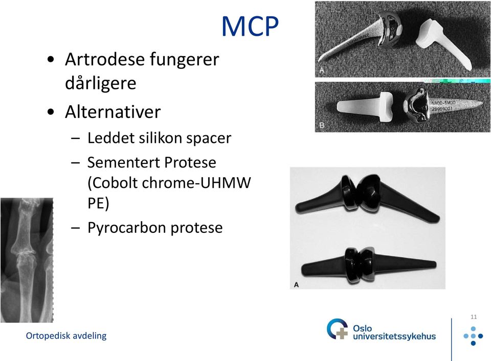 spacer MCP Sementert Protese