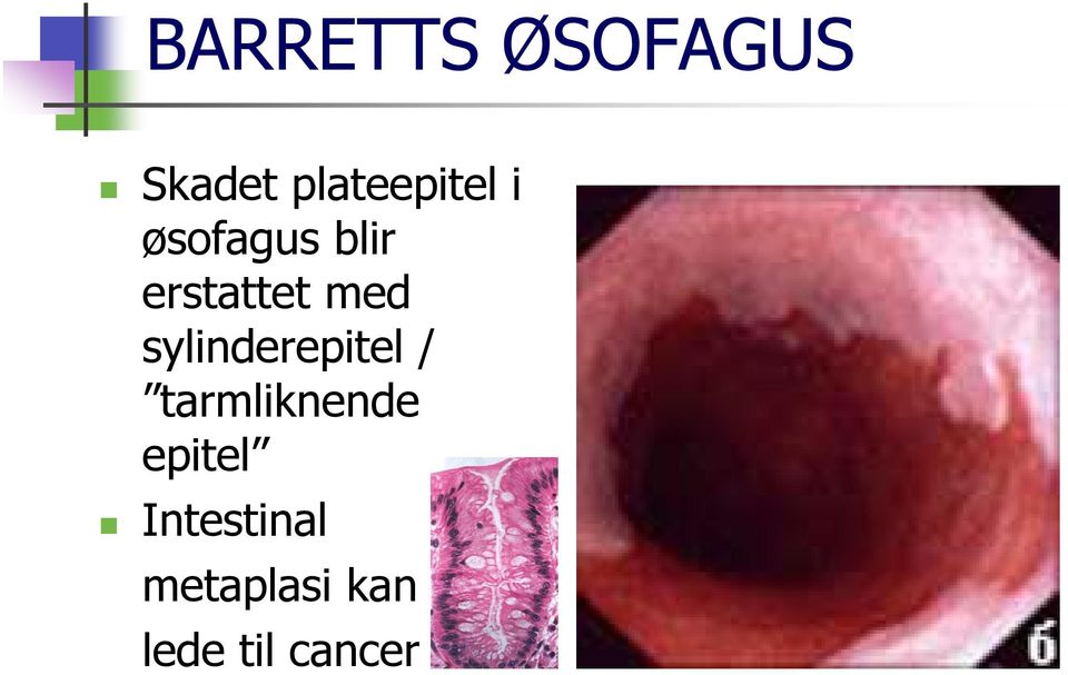 erstattet med sylinderepitel /