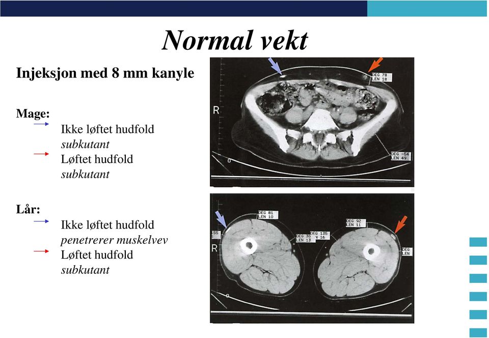 hudfold subkutant Lår: Ikke løftet hudfold