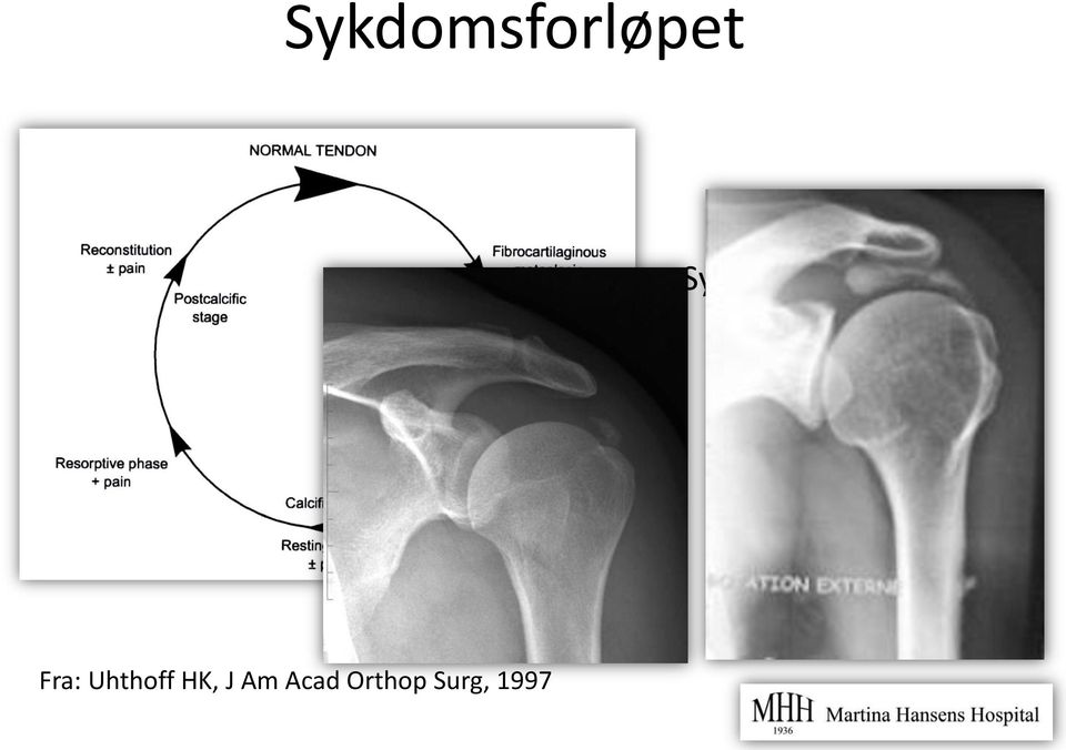 resorpsjon 1/3 vedvarende Fra: