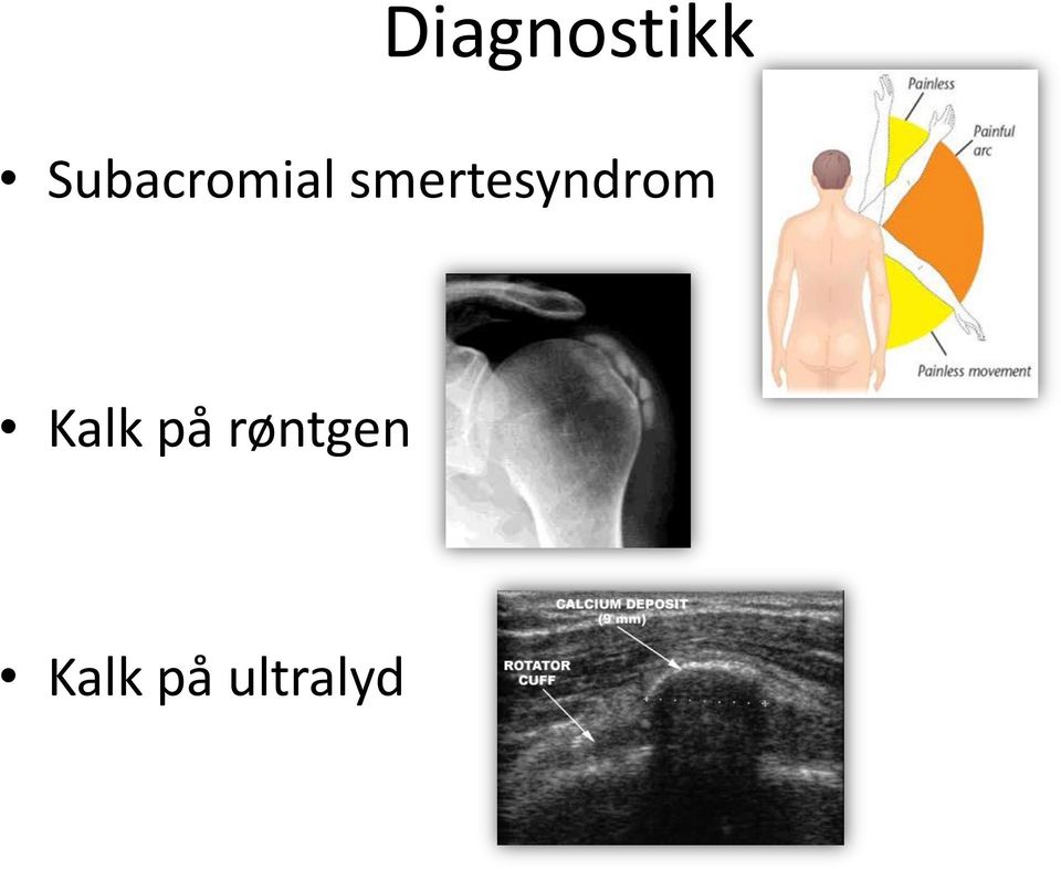 smertesyndrom