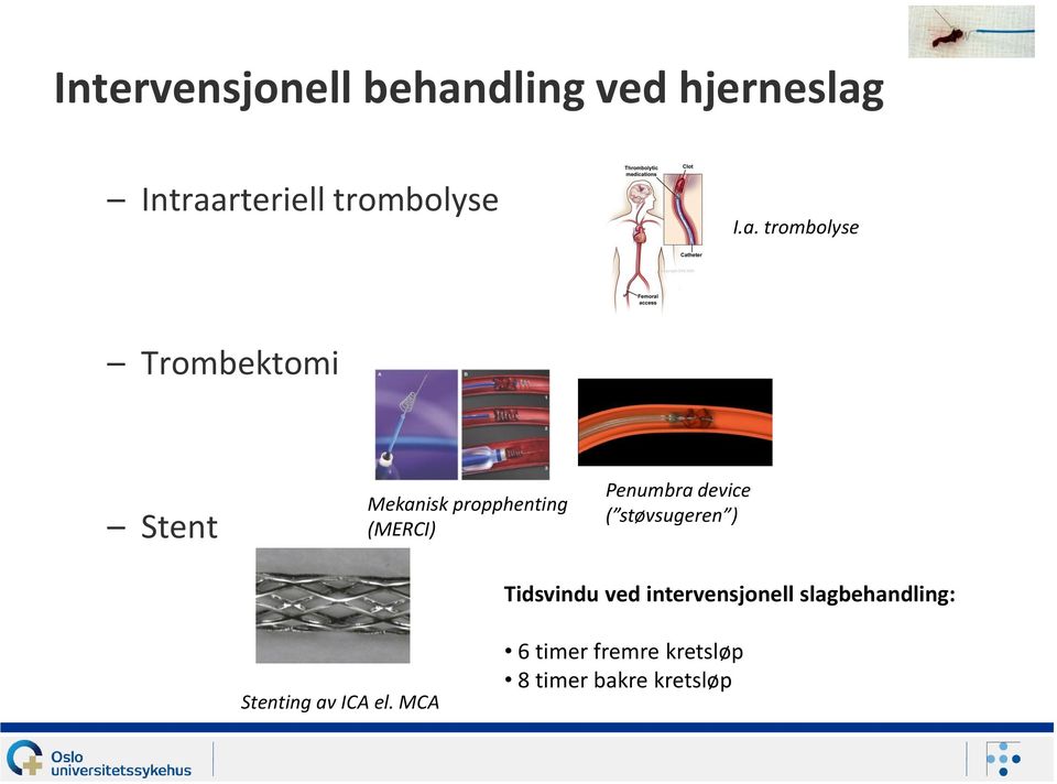 Penumbra device ( støvsugeren ) Tidsvindu ved intervensjonell