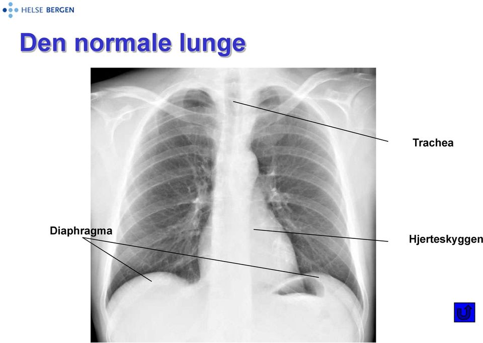 Trachea