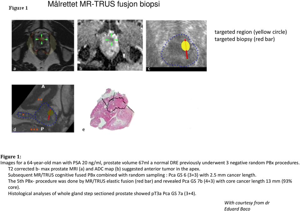 Subsequent MR/TRUS cognitive fused PBx combined with random sampling : Pca GS 6 (3+3) with 2.5 mm cancer length.