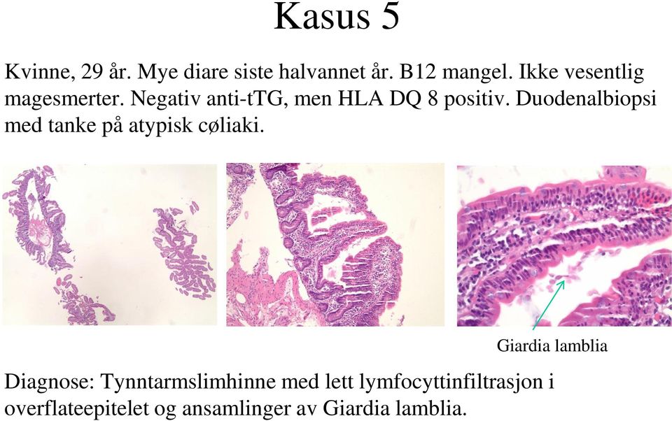 Duodenalbiopsi med tanke på atypisk cøliaki.