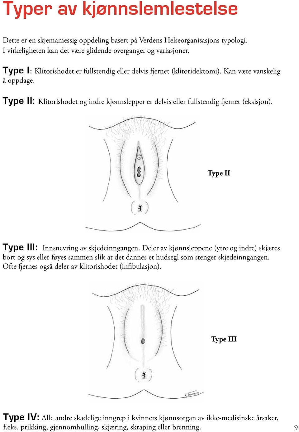 Type II: Klitorishodet og indre kjønnslepper er delvis eller fullstendig fjernet (eksisjon). Type II Type III: Innsnevring av skjedeinngangen.