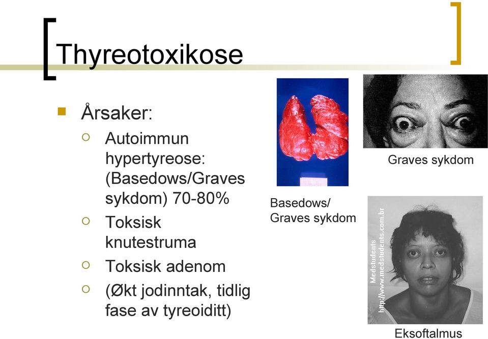 Basedows/ Graves sykdom Graves sykdom Toksisk