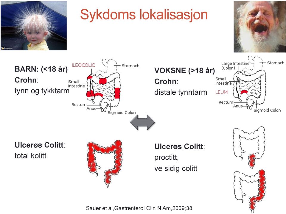 Ulcerøs Colitt: total kolitt Ulcerøs Colitt: