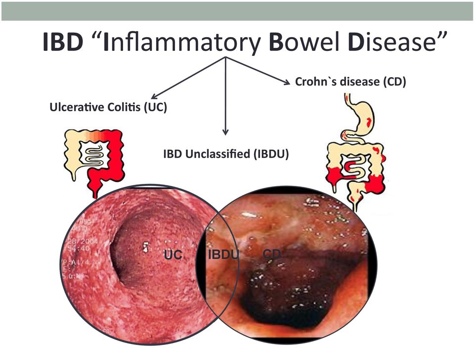 (UC) Crohn`s disease (CD) UC