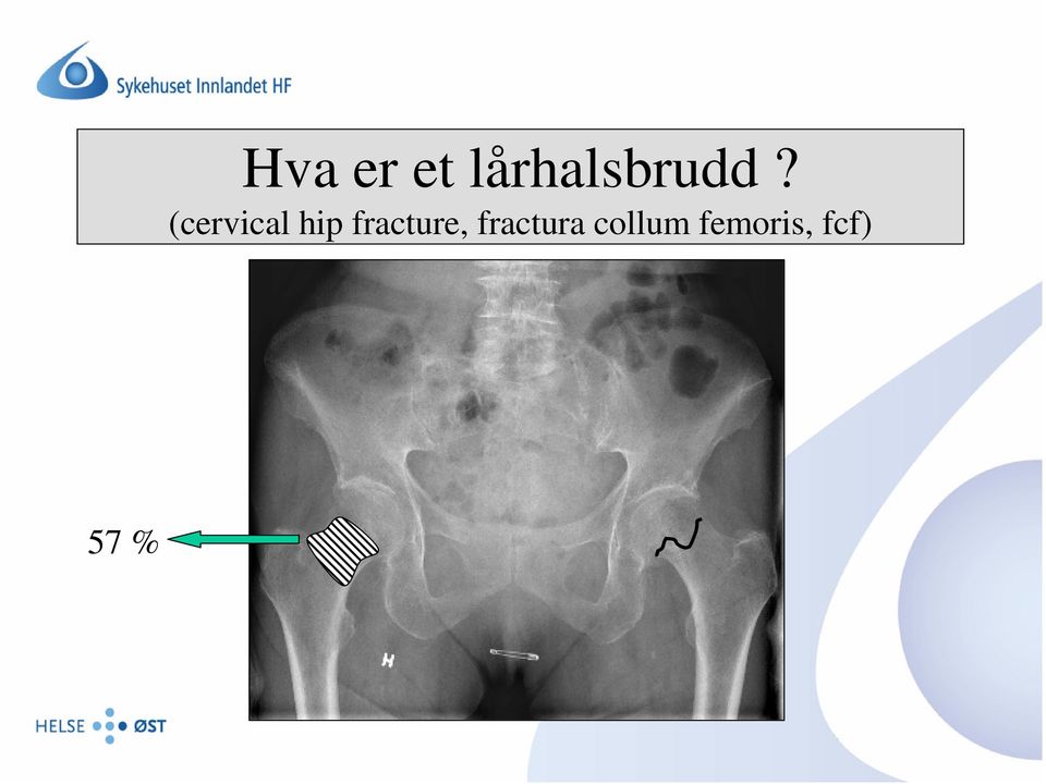 (cervical hip