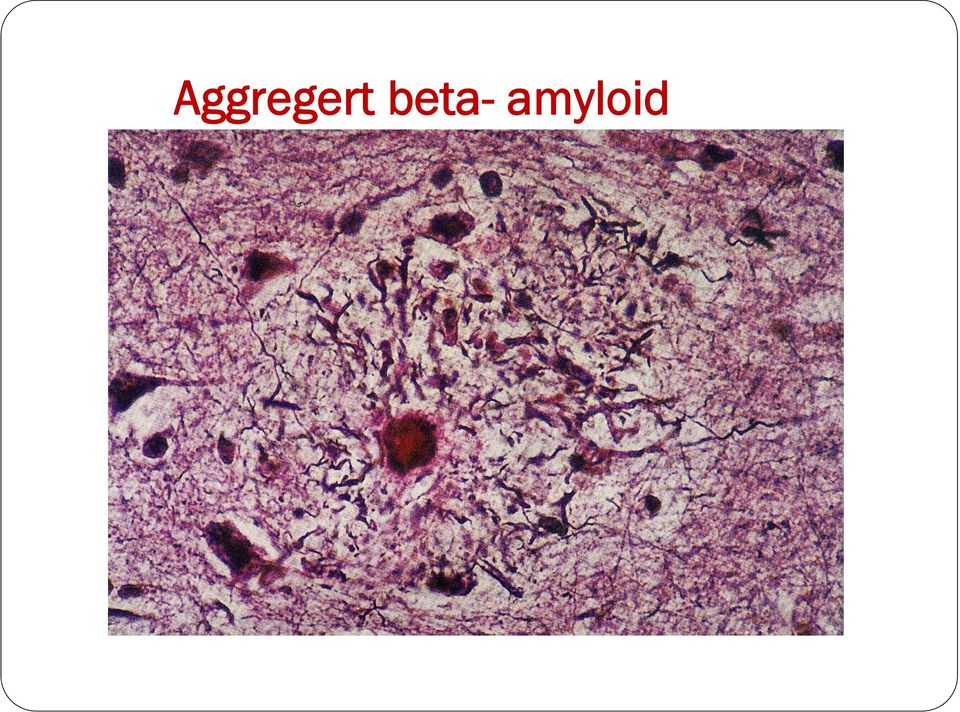 amyloid