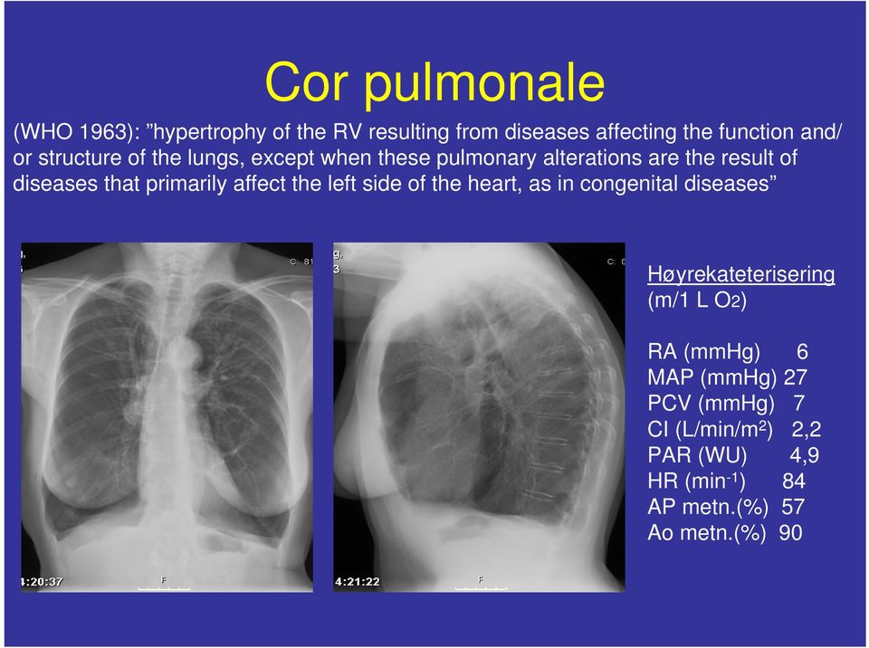 primarily affect the left side of the heart, as in congenital diseases Høyrekateterisering (m/1 L O2) RA