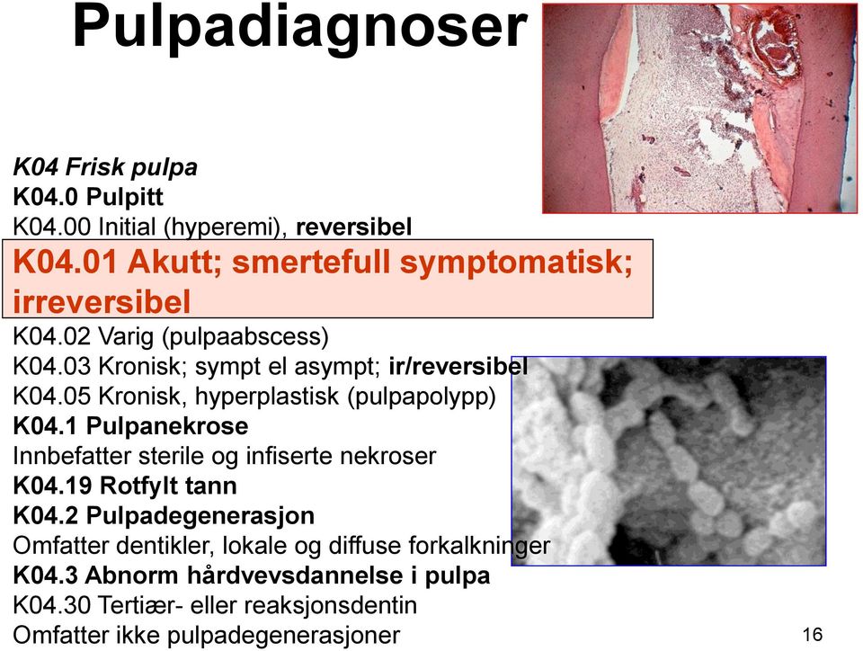 05 Kronisk, hyperplastisk (pulpapolypp) K04.1 Pulpanekrose Innbefatter sterile og infiserte nekroser K04.19 Rotfylt tann K04.