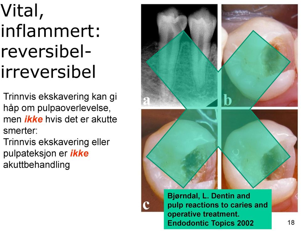 ekskavering eller pulpateksjon er ikke akuttbehandling Bjørndal, L.