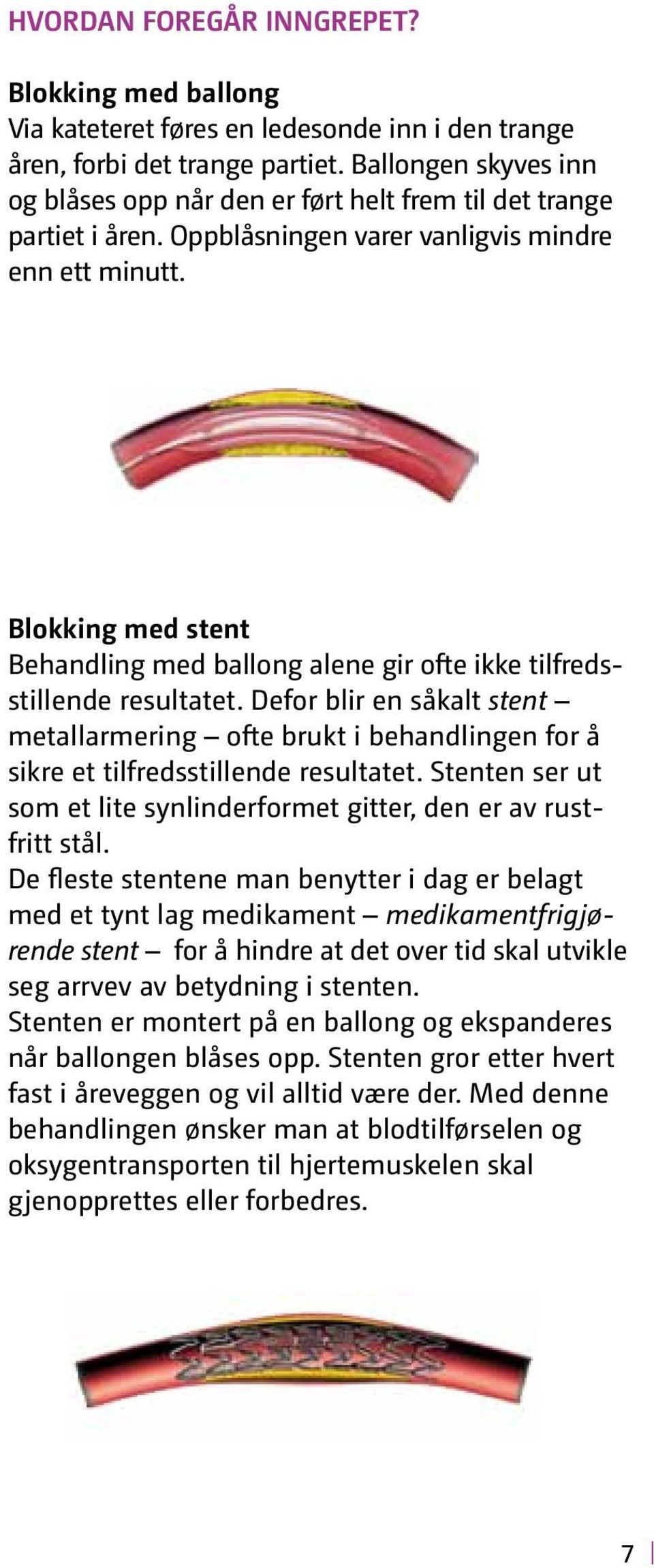 ! Blokking med stent Behandling med ballong alene gir ofte ikke tilfredsstillende resultatet.