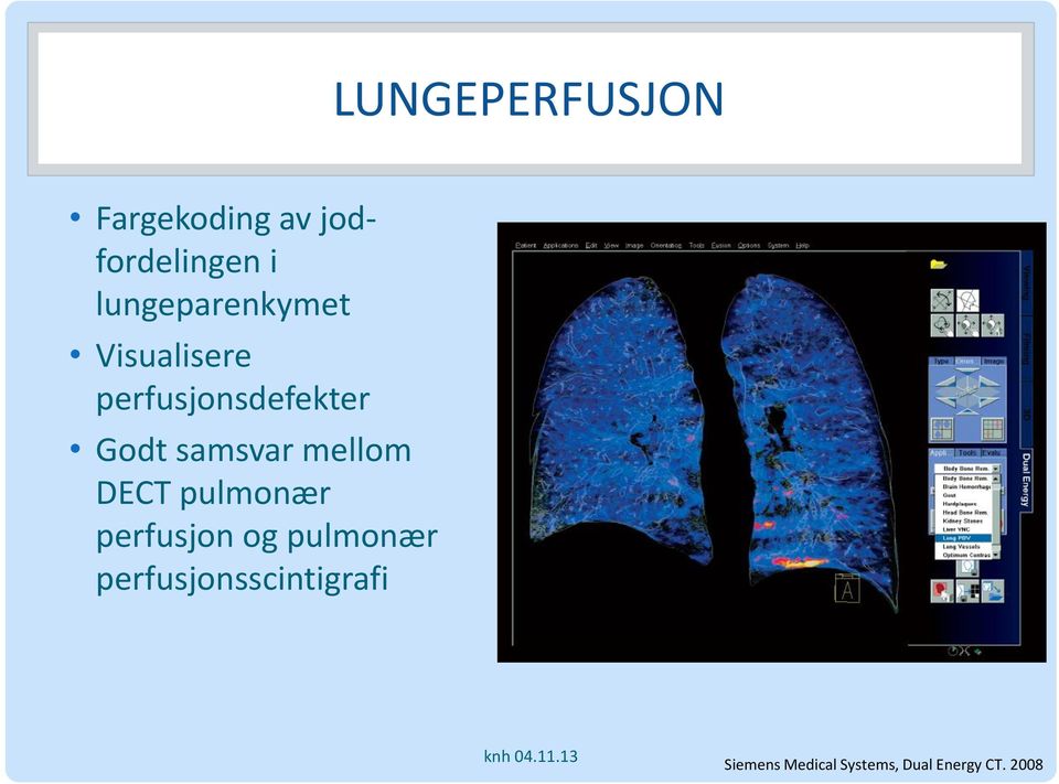 samsvar mellom DECT pulmonær perfusjon og pulmonær