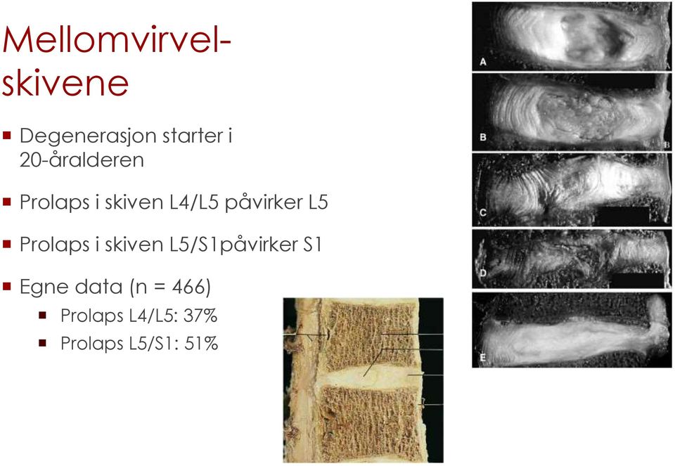 L5 Prolaps i skiven L5/S1påvirker S1 Egne