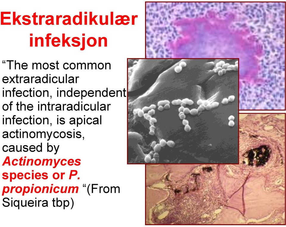 intraradicular infection, is apical actinomycosis,