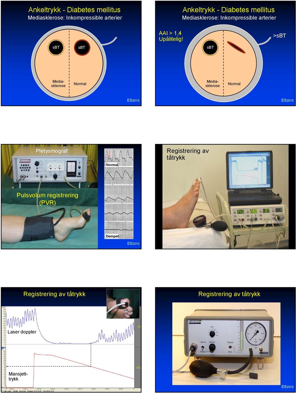 >sbt sbt sbt sbt sbt Mediasklerose Mediasklerose Pletysmograf Registrering av tåtrykk