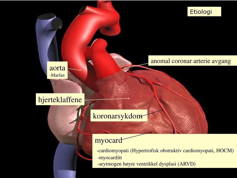 myocard -cardiomyopati (Hypertrofisk obstruktiv