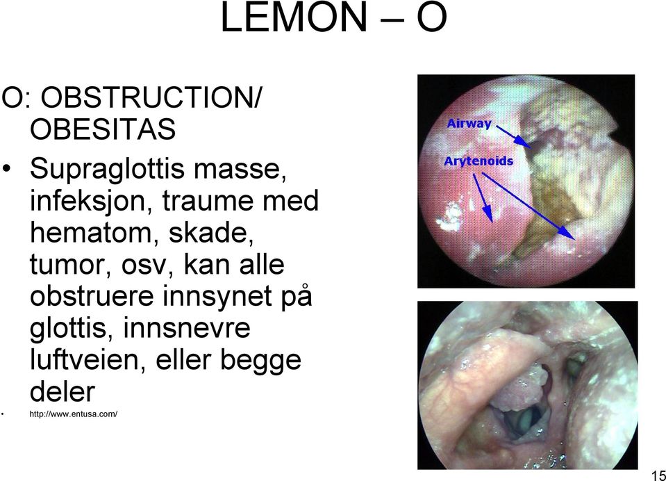 osv, kan alle obstruere innsynet på glottis,