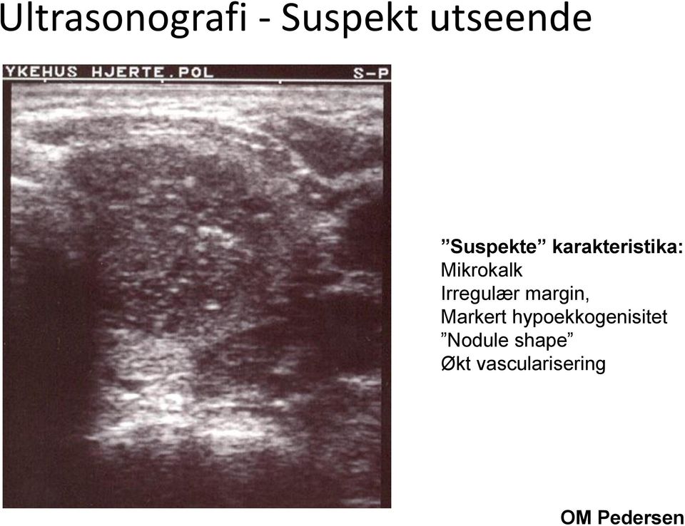 Mikrokalk Irregulær margin, Markert