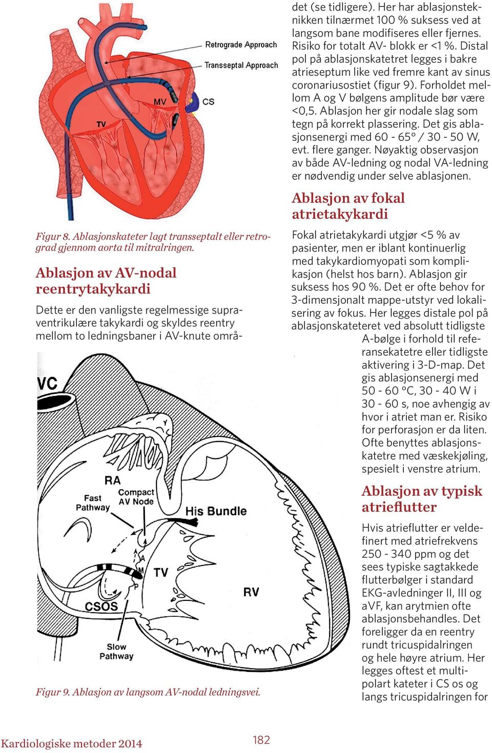 Her har ablasjonsteknikken tilnærmet 100 % suksess ved at langsom bane modifiseres eller fjernes. Risiko for totalt AV- blokk er <1 %.