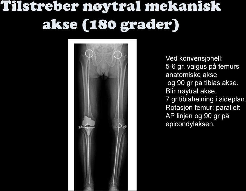 valgus på femurs anatomiske akse og 90 gr på tibias akse.