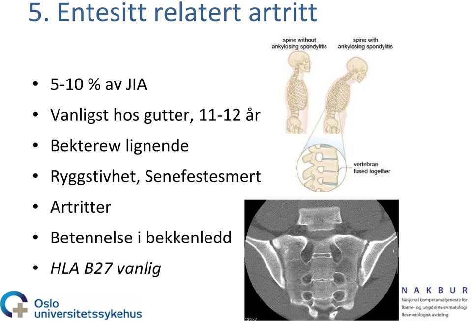 lignende Ryggstivhet, Senefestesmerter