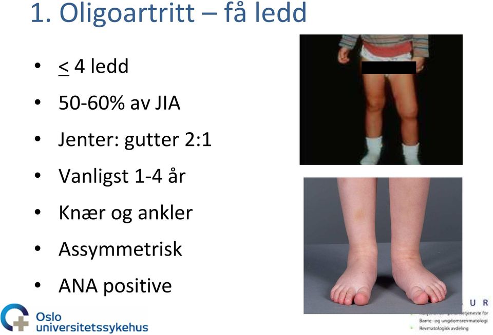 2:1 Vanligst 1-4 år Knær og