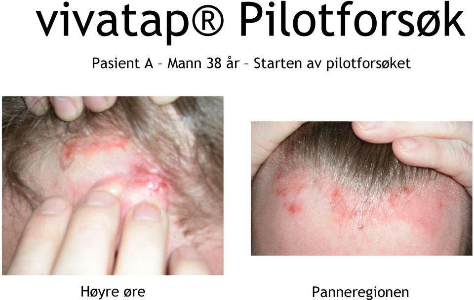 pilotforsøket Høyre øre