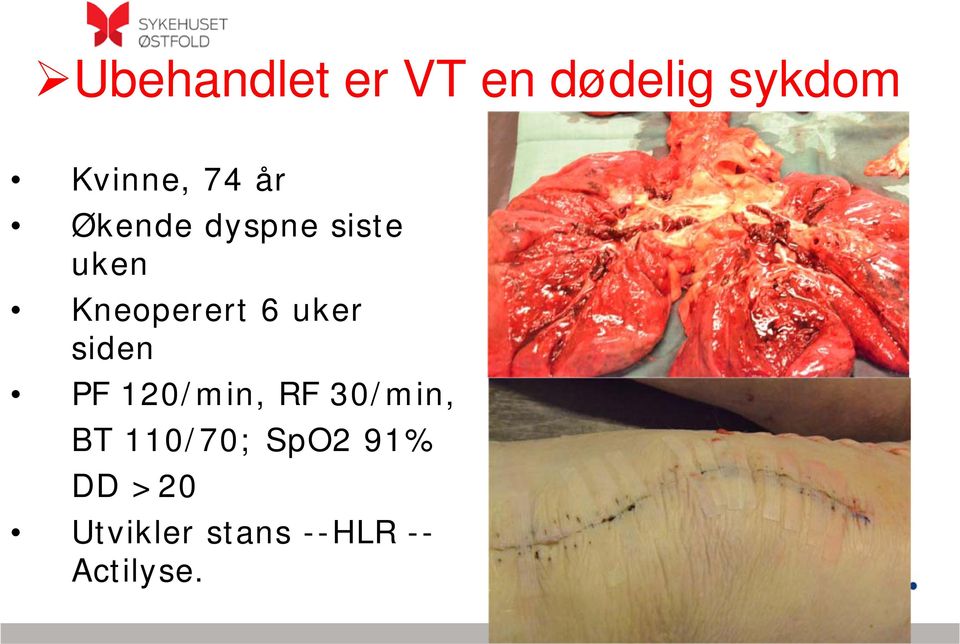 siden PF 120/min, RF 30/min, BT 110/70; SpO2