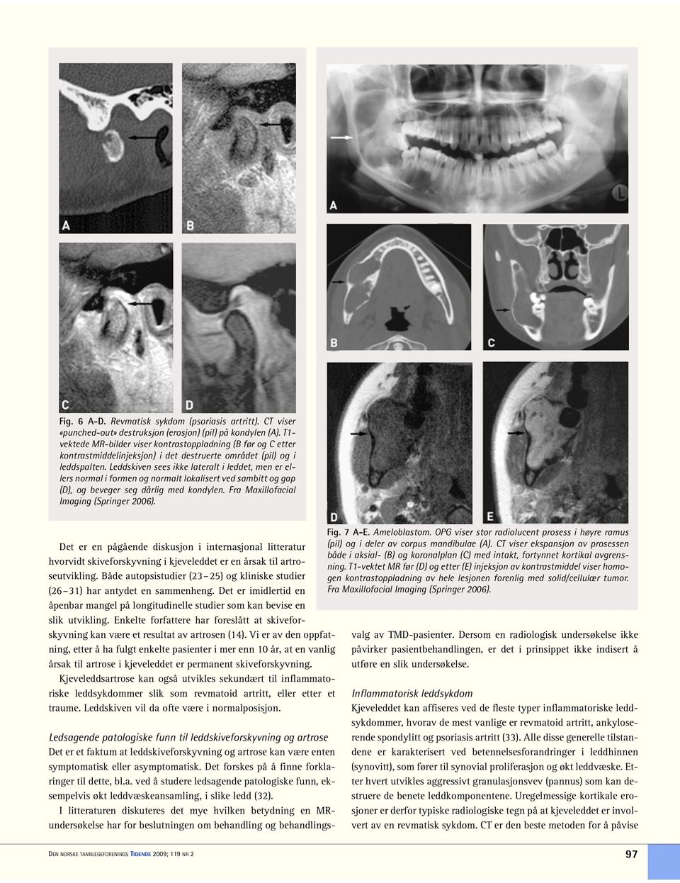Leddskiven sees ikke lateralt i leddet, men er ellers normal i formen og normalt lokalisert ved sambitt og gap (D), og beveger seg dårlig med kondylen. Fra Maxillofacial Imaging (Springer 2006).