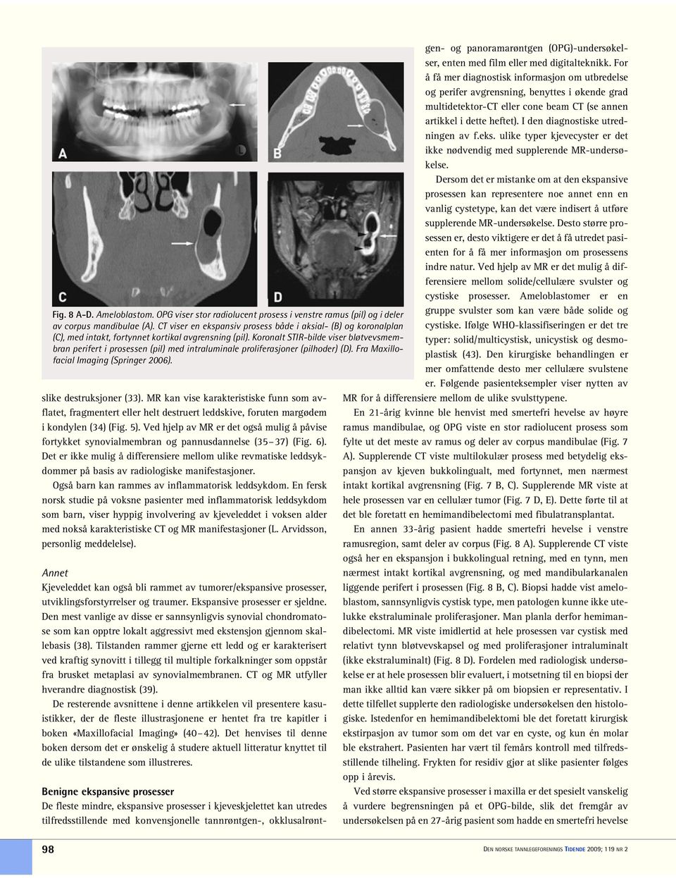 Koronalt STIR-bilde viser bløtvevsmembran perifert i prosessen (pil) med intraluminale proliferasjoner (pilhoder) (D). Fra Maxillofacial Imaging (Springer 2006). slike destruksjoner (33).