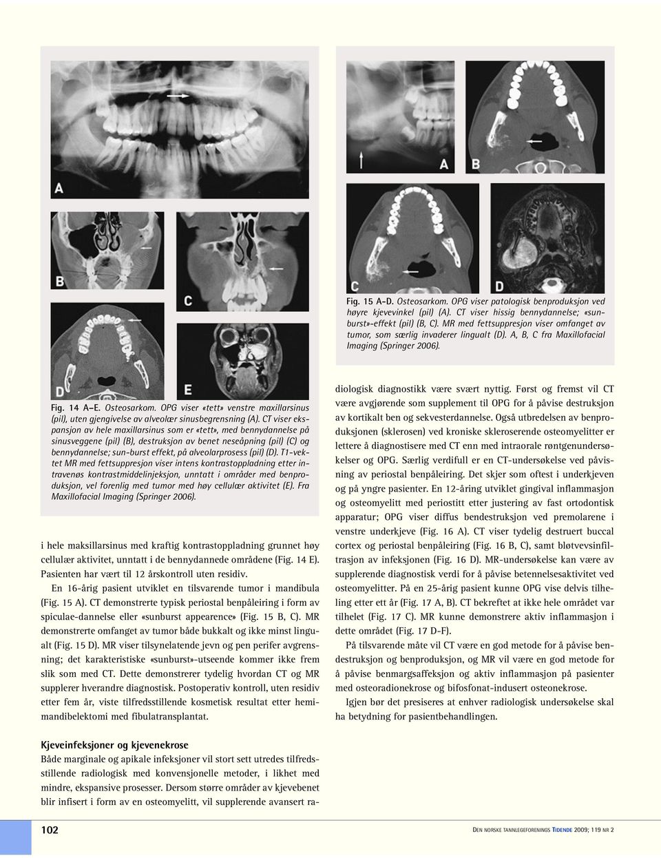 OPG viser «tett» venstre maxillarsinus (pil), uten gjengivelse av alveolær sinusbegrensning (A).