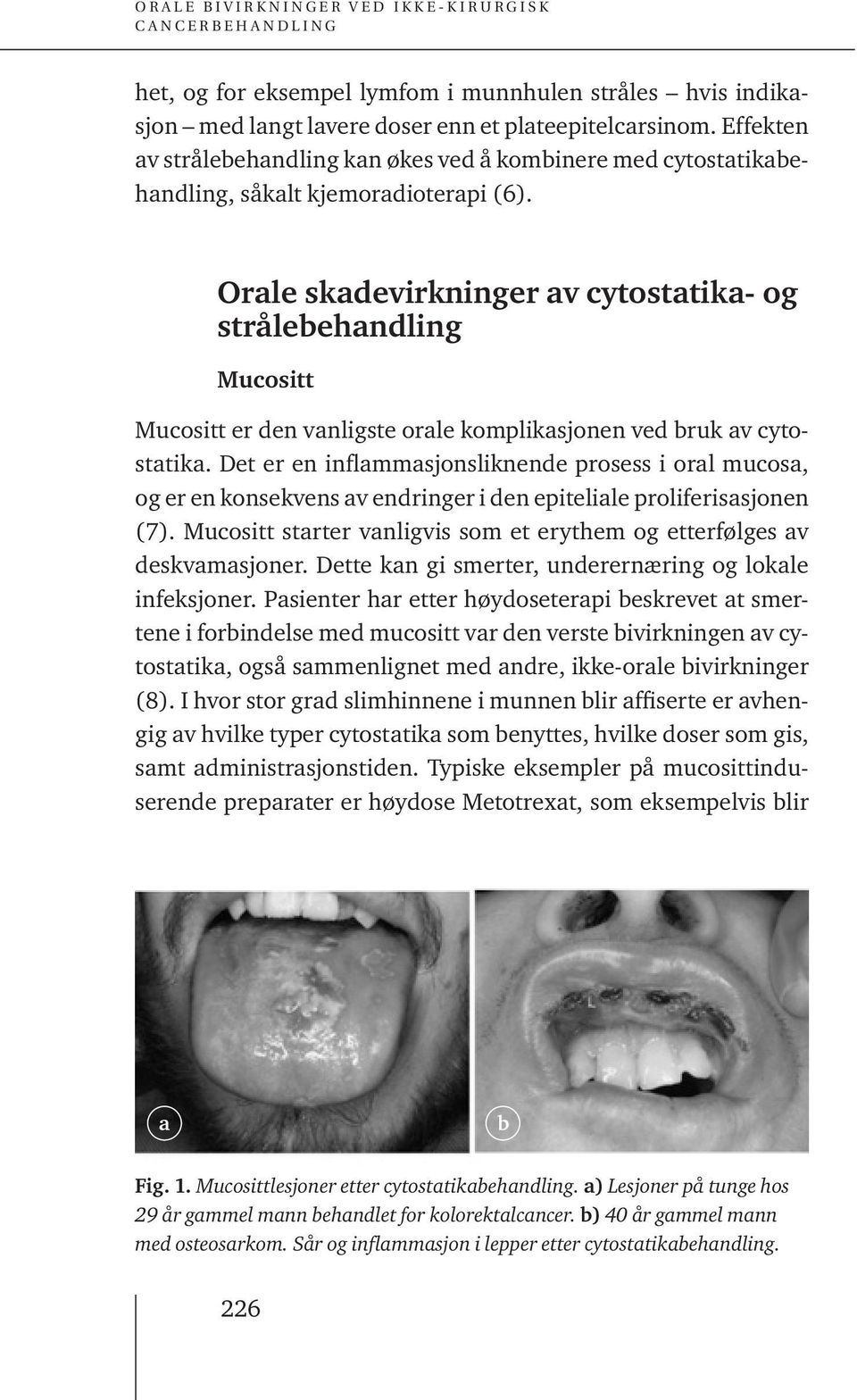 Orale skadevirkninger av cytostatika- og strålebehandling Mucositt Mucositt er den vanligste orale komplikasjonen ved bruk av cytostatika.