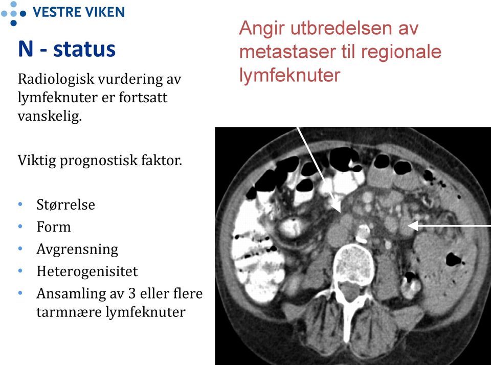 Angir utbredelsen av metastaser til regionale lymfeknuter