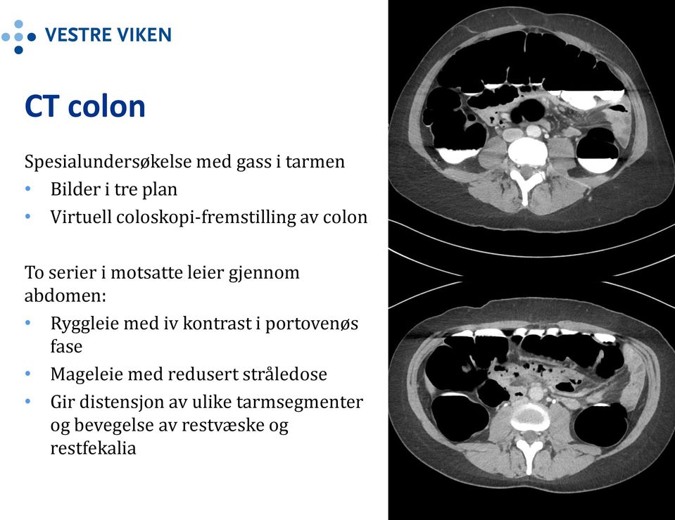 Ryggleie med iv kontrast i portovenøs fase Mageleie med redusert stråledose