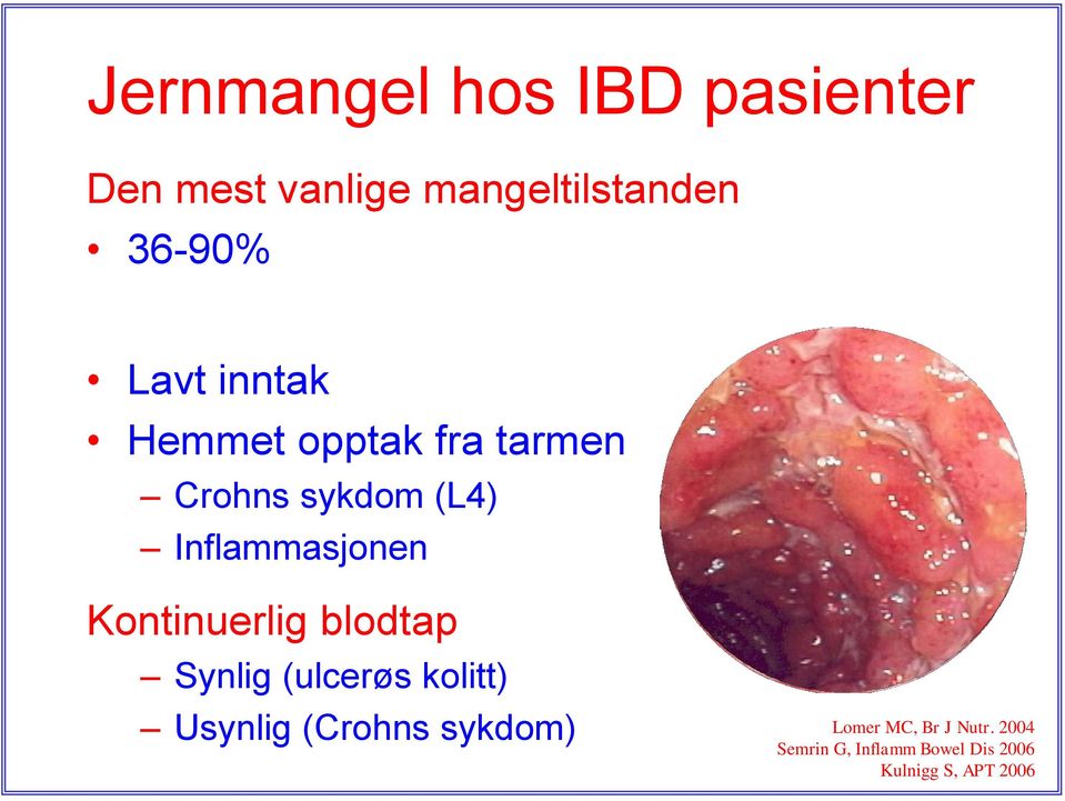 Kontinuerlig blodtap Synlig (ulcerøs kolitt) Usynlig (Crohns sykdom)