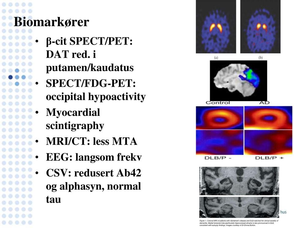 hypoactivity Myocardial scintigraphy MRI/CT: less