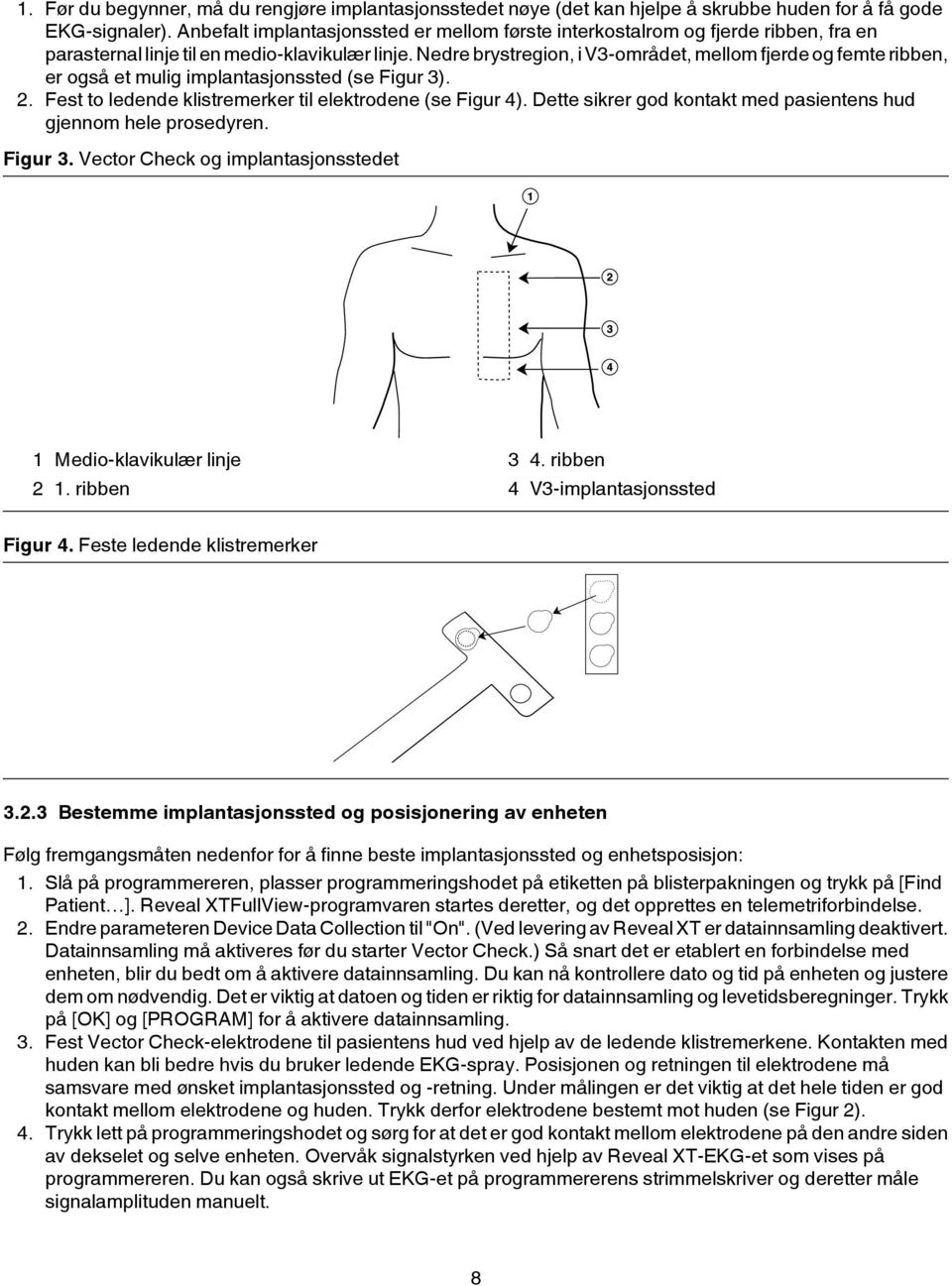 Nedre brystregion, i V3-området, mellom fjerde og femte ribben, er også et mulig implantasjonssted (se Figur 3). 2. Fest to ledende klistremerker til elektrodene (se Figur 4).