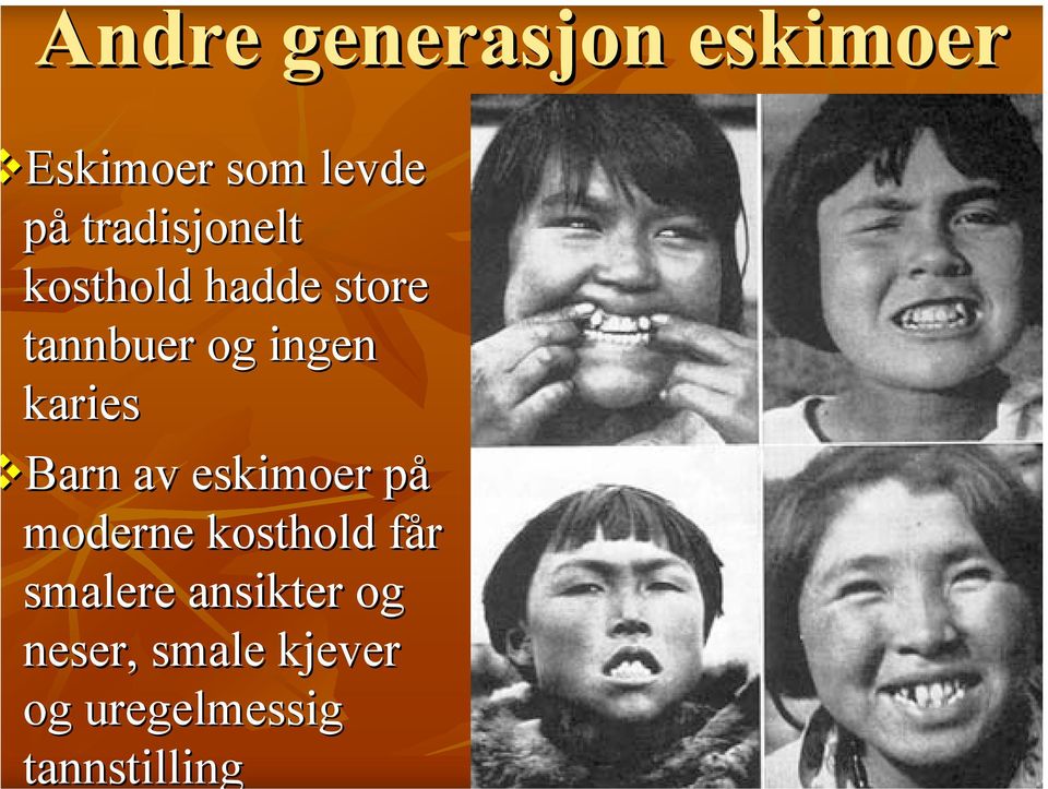 karies Barn av eskimoer påp moderne kosthold får f